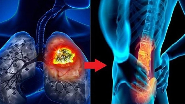 Ung thư phổi giai đoạn 4 các tế bào di căn sang xương